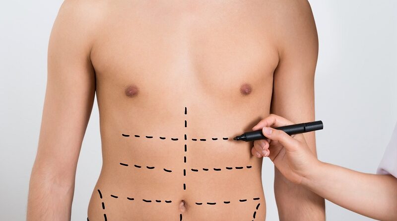 Liposuction