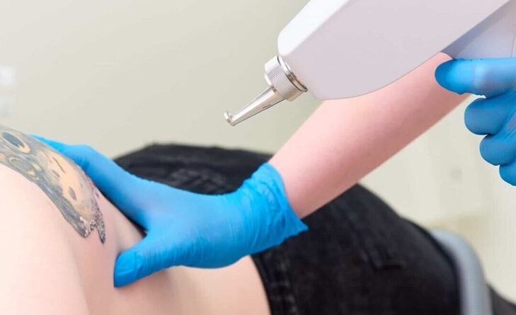 Laser Tattoo Removal