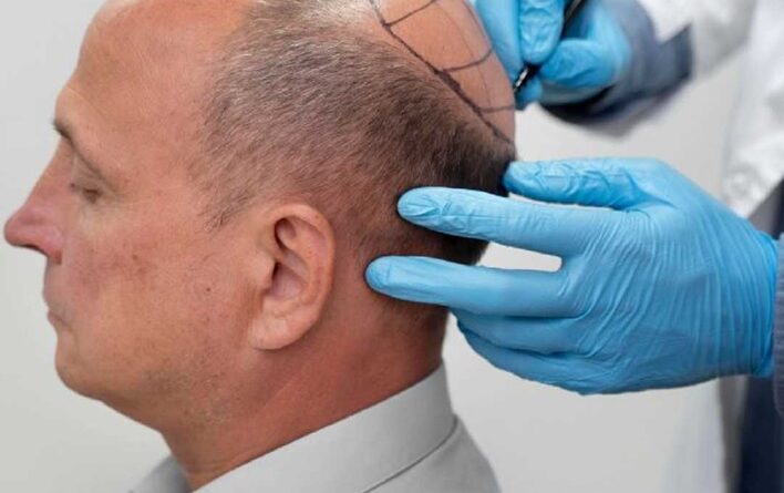 The Risks and Side Effects of Hair Transplant Surgery